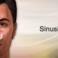 sinusitis