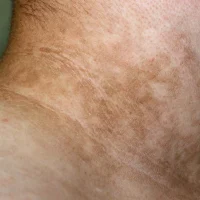 Acanthosis Nigricans