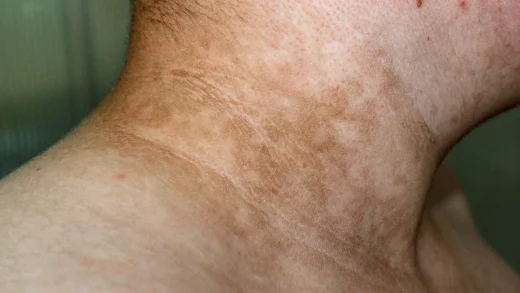 Acanthosis Nigricans