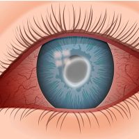 Acanthamoeba Keratitis