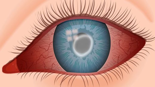 Acanthamoeba Keratitis