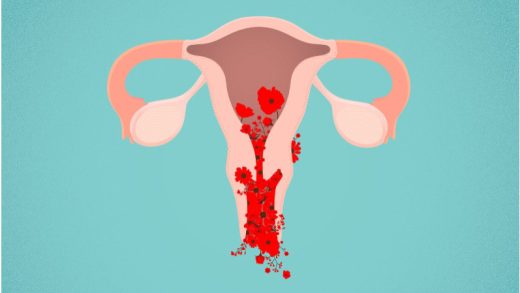 Abnormal Uterine Bleeding