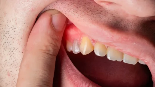 Abscessed Tooth