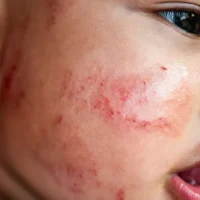 Baby Eczema